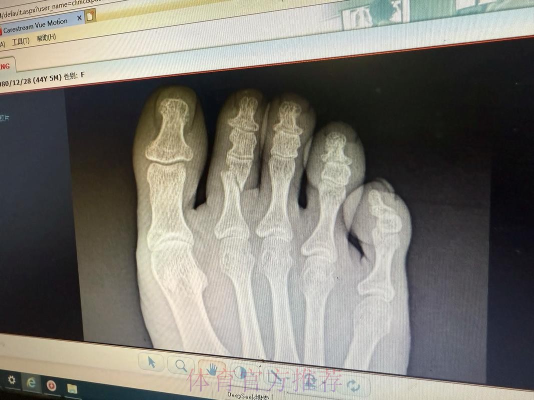 皇马官方:琼阿梅尼左脚第二跖骨不完全应力性骨折